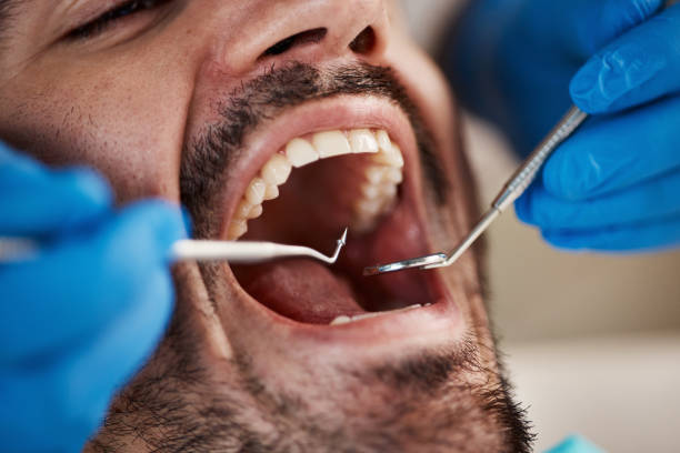 Best Emergency Tooth Extraction in Fairview, OR